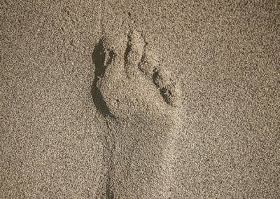What are bruised heels or bruised fat pads – Diagnosis, Treatment and Pain Relief