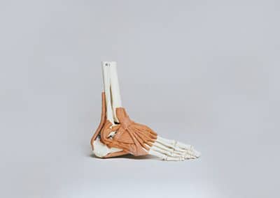 What is Heel Pain and Calcaneal Stress Fractures – Diagnosis, Treatment and Pain Relief