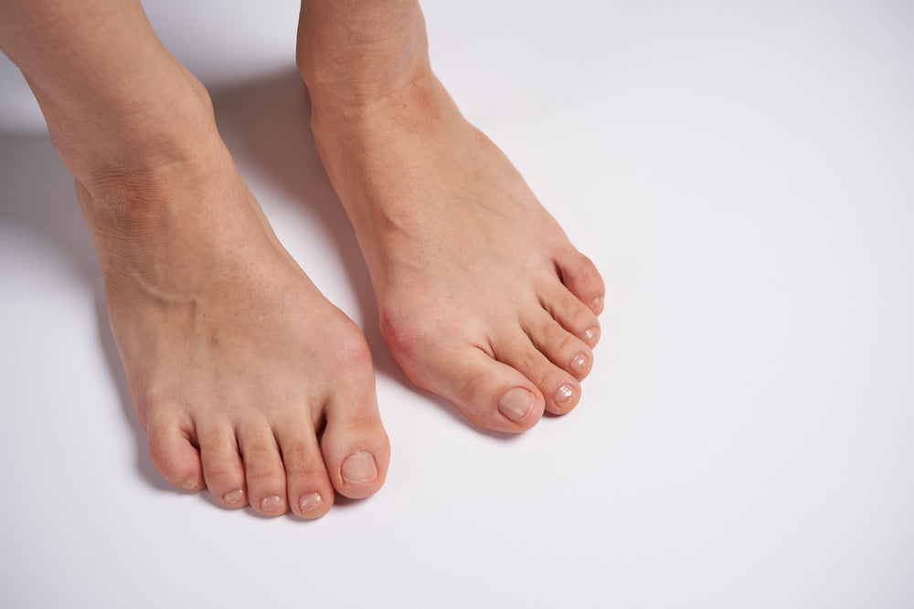 Two feet with bunions on a white background