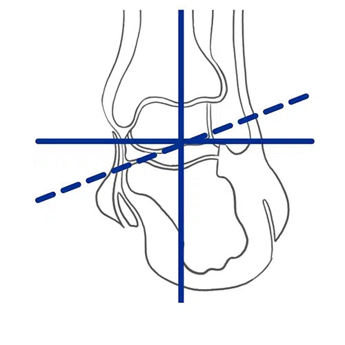 Diagram of pronated foot